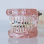 Jak działa aparat ortodontyczny rozszerzający szczękę?